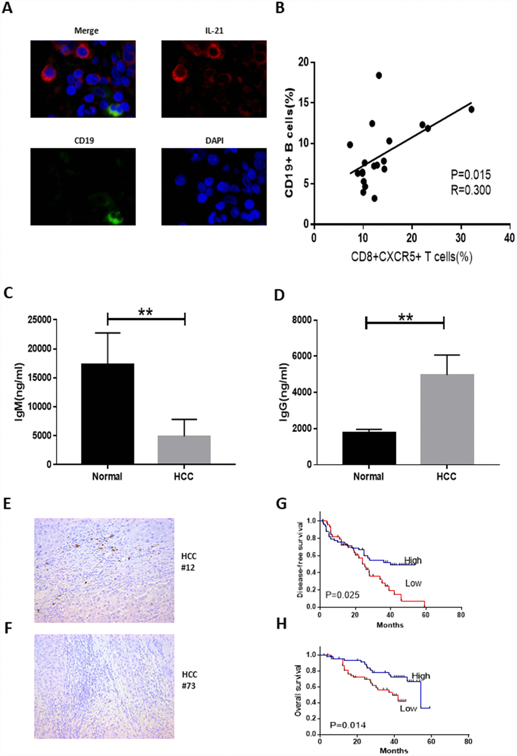 Tumor-infiltrating CD8+CXCR5+ T cells from HCC patients are potent inducers of plasmablasts differentiation in vitro. (A) Representative immunofluorescence images of CD19 (green), IL-21 (red) and nuclear staining with DAPI (blue) in HCC tissue. (B) Associations between tumor-infiltrating CD8+CXCR5+ T cells and tumor-infiltrating CD19+ B cells (n=19). (C–D) Coculture of autologous CD19+ B cells with healthy blood CD8+CXCR5+ T cells or tumor-infiltrating CD8+CXCR5+ T cells. On day 5, the supernatants were harvested. IgG (C) and IgM levels (D) were determined using an ELISA (n=3). (E–F) Immunohistochemical staining of CD138+ B cells in paraffin-embedded HCC tissue (n=96). (G–H) Patients were divided into two groups (Low/High) based on the median of the tumor-infiltrating CD138+ B cell percentages. The DFS and OS curves between the two patient groups were compared using the log-rank test. **P