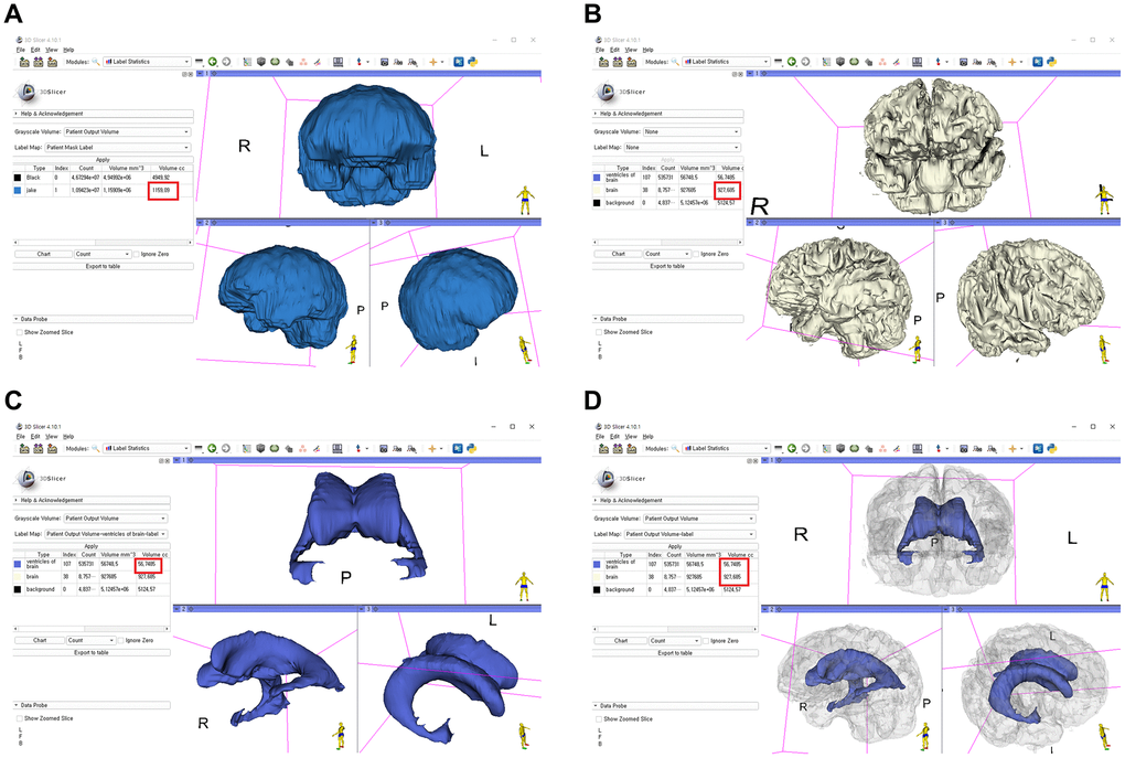 Segmentation of the intracranial cavity, brain parenchyma, and lateral ventricles with a 3D-reconstructed model using the 3D slicer and calculation of each volume (red box indicates the volume). (A) Intracranial cavity; (B) brain parenchyma; (C) lateral ventricles; (D) merge of the brain parenchyma and lateral ventricles.