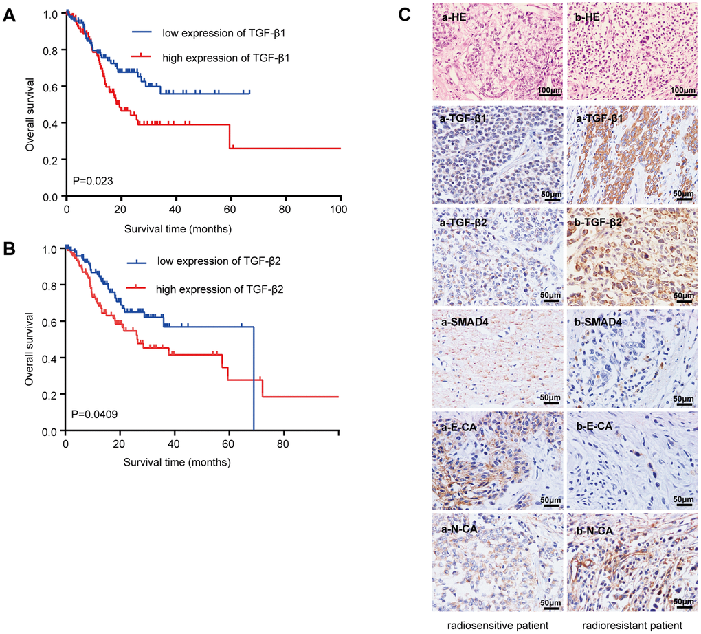 Relationship between the TGF-β expressions with the overall survival and radioresistance in GC patients. (A) Kaplan-Meier survival curves for high and low mRNA TGF-β1 expression level in GC patients. (B) Kaplan-Meier survival curves for high and low mRNA TGF-β2 expression level in GC patients. (C) Immunohistochemical analysis: representative immunohistochemistry images of the TGF-β1, TGF-β2, SMAD4, E-CA and N-CA expressions in biopsy samples of GC patients. (a) Specimen from a patient whose tumor sample showed a complete response to radiotherapy (radiosensitive GC patient). (b) Specimen from a patient whose tumor sample showed no change after radiotherapy (radioresistant GC patient). Original magnification, ×400. P0.05.