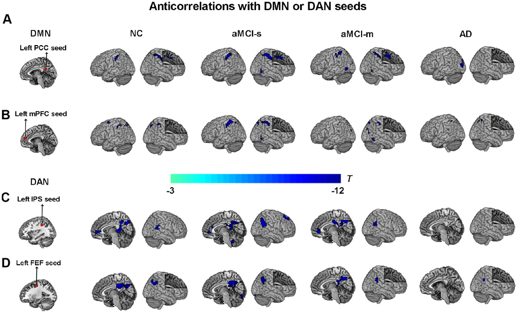 Anticorrelations between the DMN and DAN among the four groups. (A) The left PCC seed (red color) showing anticorrelations with the DAN (cool colors) among the four groups; (B) The left mPFC seed (red color) showing anticorrelations with the DAN (cool colors) among the four groups; (C) The left IPS seed (red color) showing anticorrelations with the DMN (cool colors) among the four groups; (D) The left FEF seed (red color) showing anticorrelations with the DMN (cool colors) among the four groups. P 