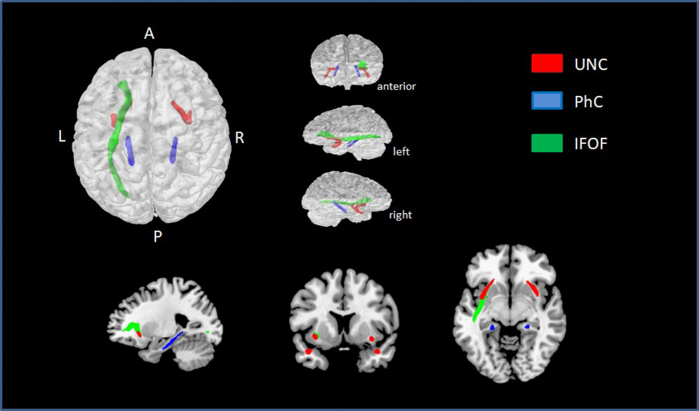 ROIs with statistically significant correlations between MD values and NProd (FDR q  UNC is represented in red, PhC in blue, and left IFOF in green.