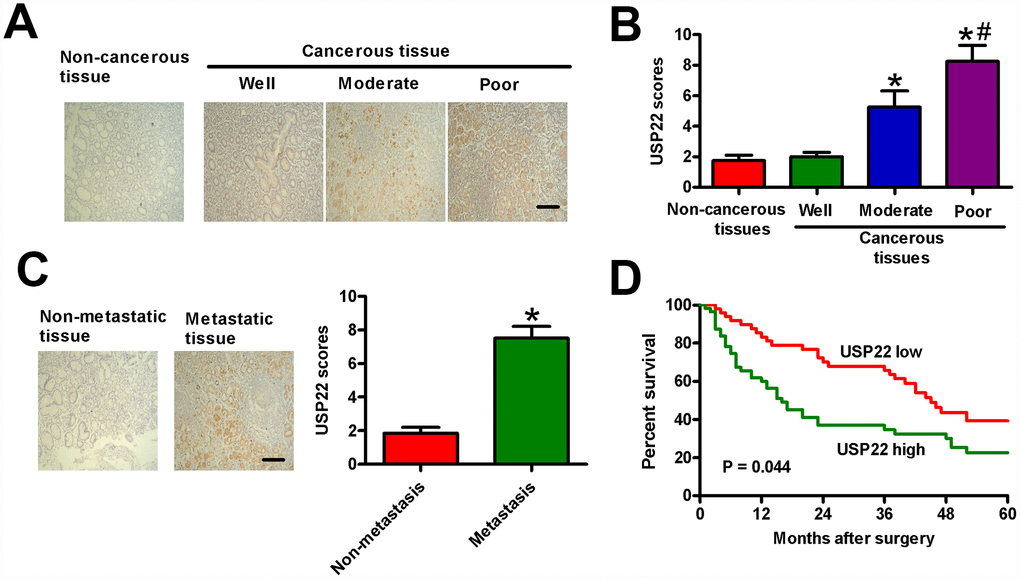 USP22 overexpression positively correlates with advanced histological grade, metastasis, and poor prognosis in GC patients. (A) Representative images of IHC staining of USP22 and (B) USP22 expression scores in the sections of non-cancerous and GC tissues at various stages of differentiation. Scale bar: 10 μm. (C) USP22 expression scores in metastatic and non-metastatic GC tissue samples (n = 40). (D) Relationship between levels of USP22 expression based on IHC and the five-year overall survival (OS) rates after surgery in GC patients with high-USP22 (n = 107) and low-USP22 (n = 79) expression. Note: Data are expressed as mean ± SD of three replicates; *p B); *p C); #p B).