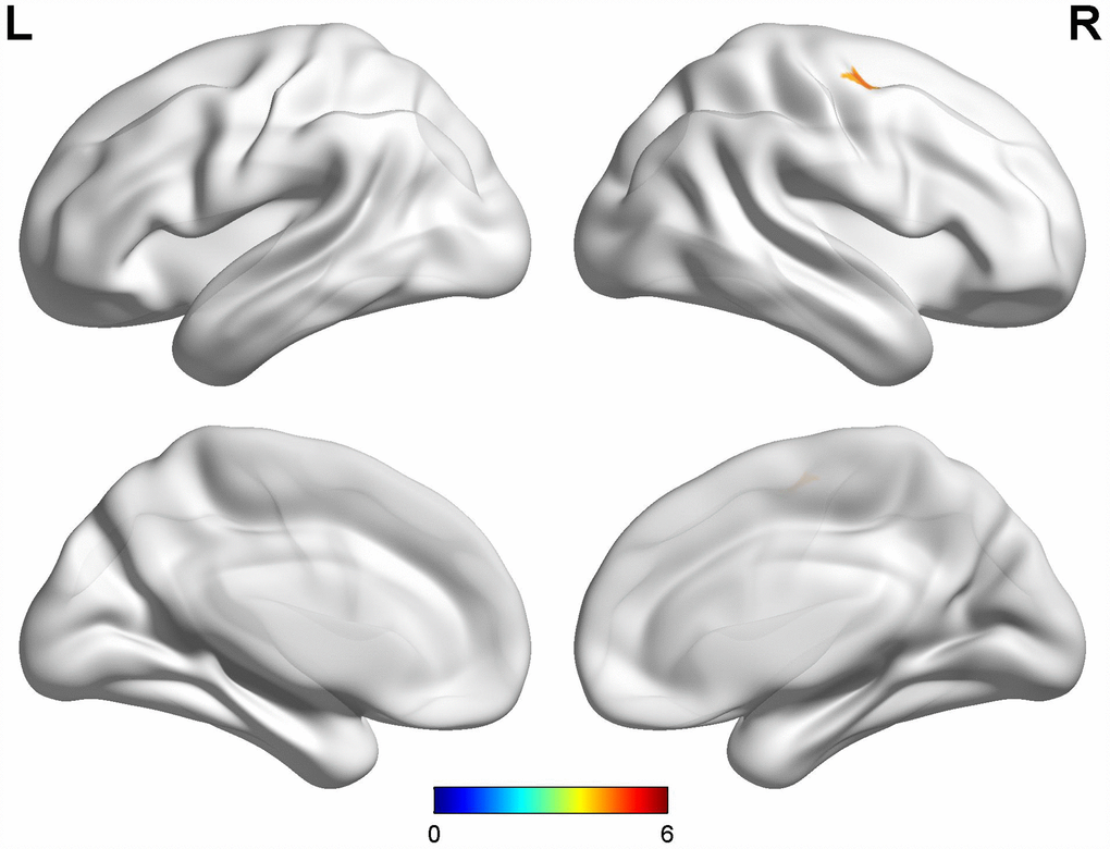 Comparison between early-onset PD patients with diphasic dyskinesia and early-onset PD patients without dyskinesia. Compared with early-onset PD patients without dyskinesia, early-onset PD patients with diphasic dyskinesia showed higher GM volumes in right precentral gyrus (Cluster size: 162 mm3). Correction for multiple comparisons (family-wise error rate (FWE), P 