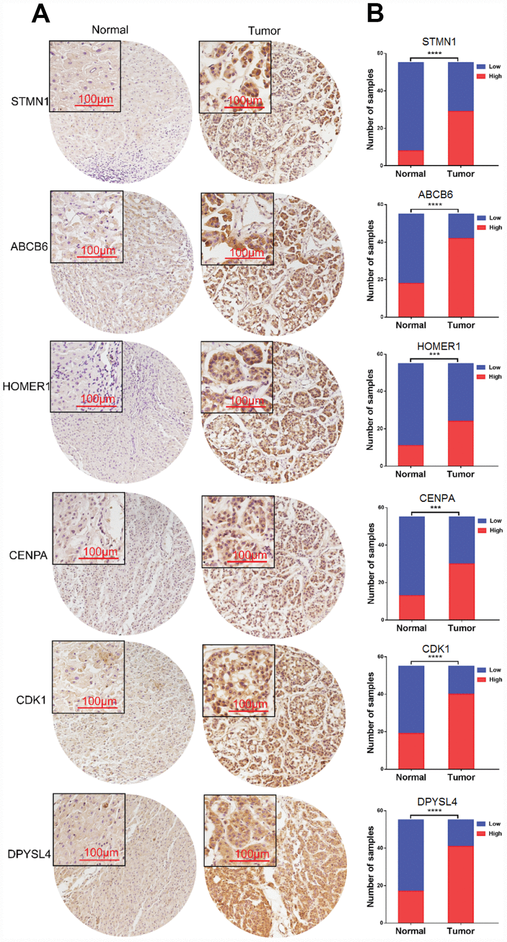 Expression of six proteins in HCC tissues. (A) Representative immunohistochemistry staining of the six proteins, (B) The sample number of high and low expression of each protein. (***p