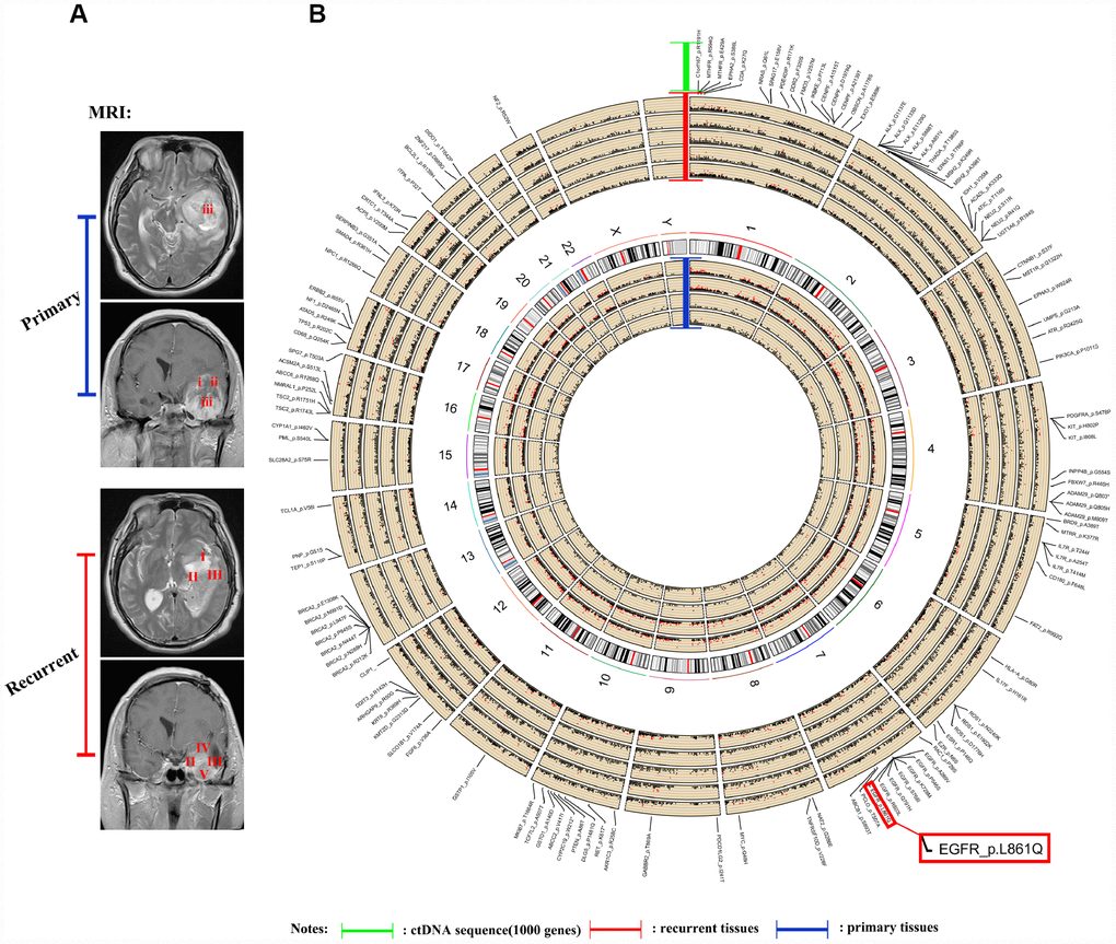 Sequencing and analysis of the ctDNA. (A) Magnetic resonance images show the different locations of tissue samples derived from patient NO. 05. (B) SNP density circos map of the primary and recurrent GBM samples from patient NO. 05. The first circle represents sample (i), the second circle represents sample (ii), the third circle represents sample (iii), the fourth circle represents the repeat of sample (iii), the fifth circle represents chromosomes, the sixth circle represents sample (I), the seventh circle represents sample (II), the eighth circle represents sample (III), the ninth circle represents sample (IV), the tenth circle represents sample (V), and the eleventh circle represents gene mutations detected using ctDNA testing.