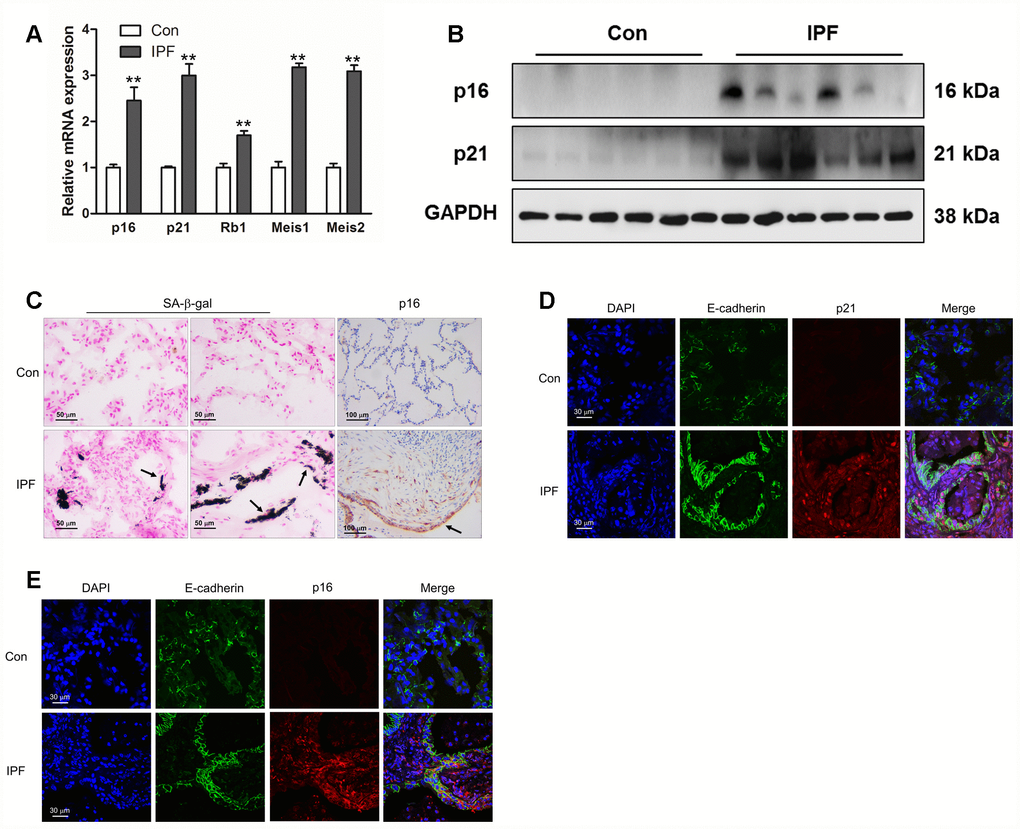 Increased epithelial cell senescence occurred in idiopathic pulmonary fibrosis (IPF). (A) The mRNA levels of p16 and p21 were measured by Q-PCR, **P B) The protein levels of collagen I, p16 and p21 were measured by Western blot. (C) SA-β-gal activity was revealed by X-gal staining. The expression of p16 was determined by immunohistochemical analysis. (D, E) The normal lung (Con) and lung of a patient with idiopathic pulmonary fibrosis (IPF) were double stained with E-cadherin and p21 (D) or p16 (E) by immunofluorescence.