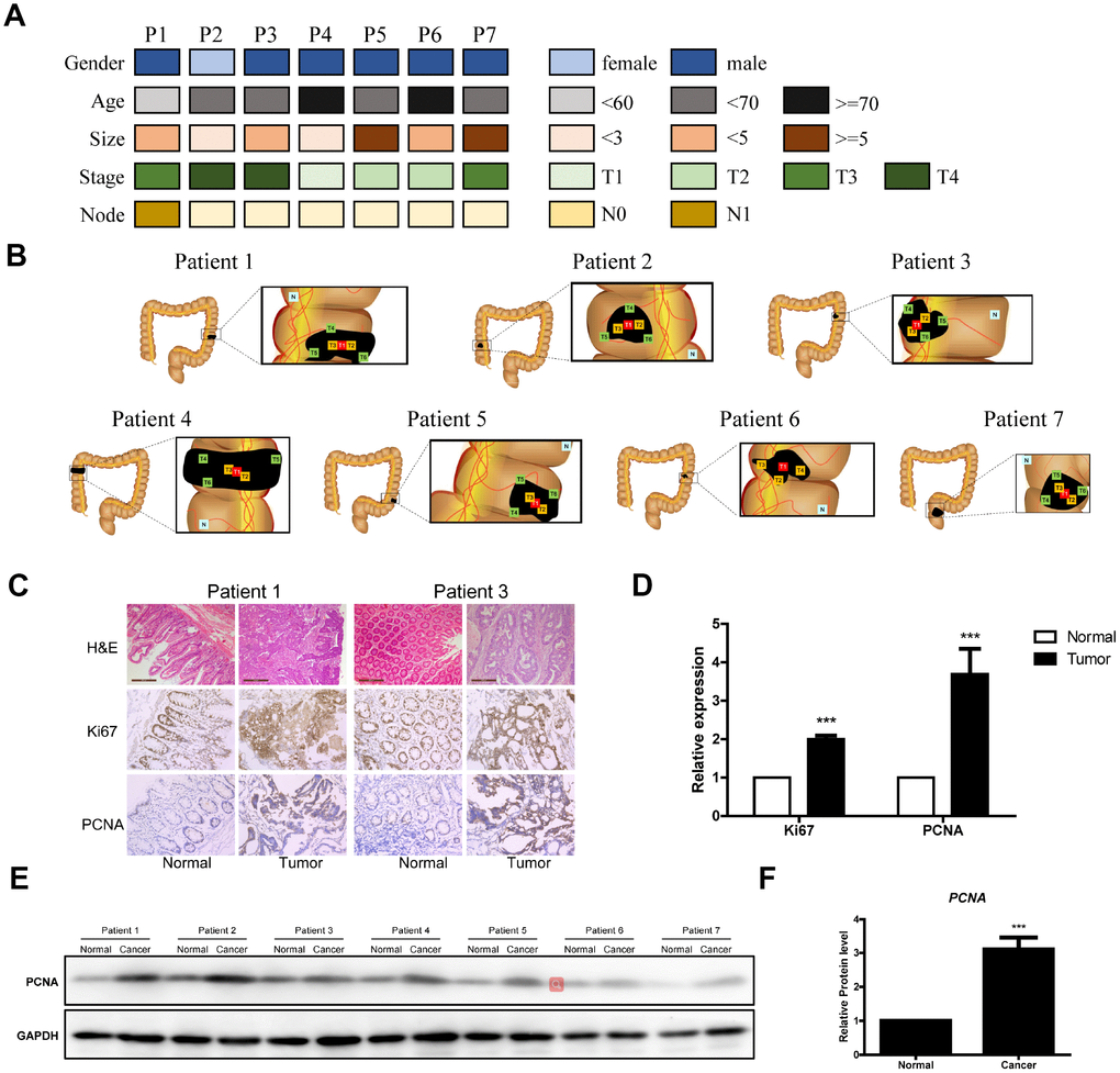 Clinical data of the seven CRC patients. (A) Clinical analyses of seven CRC patients. (B) Schematic diagram of the locations of the tumor tissues from the seven patients. (C) Representative images of H&E Staining, Ki67 immunostaining and PCNA immunostaining of samples from the seven patients. (D) Data analysis of Ki67 immunostaining and PCNA immunostaining of tumor tissue sections. (E and F) Western blot of PCNA in tumor tissue sections.