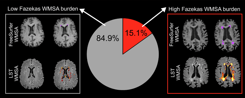 Prevalence of low and high Fazekas WMSA burden. Low WMSA burden was defined as Fazekas scores 0 (i.e. absence of WMSA) or 1 (i.e. punctate WMSA). High WMSA burden was defined as Fazekas scores 2 (i.e. early confluent WMSA) and 3 (i.e. WMSA in large confluent areas). The gray box illustrates automatic segmentations of WMSA by FreeSurfer (first row) and LST (second row), for a representative subject with low Fazekas WMSA burden. The red box illustrates automatic segmentations of WMSA by FreeSurfer (first row) and LST (second row), for a representative subject with high Fazekas WMSA burden. WMSA: White matter signal abnormalities; LST: Lesion segmentation tool.