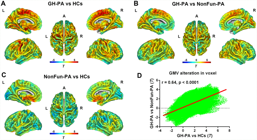 Distribution of GMV alterations in voxel level among the three groups. VBM analysis showing the GMV alteration in GH-PA vs HCs (A), in GH-PA vs NonFun-PA (B), in NonFun-PA vs HCs (C). Correlation analysis of GMV alteration pattern between GH-PA vs HCs and GH-PA vs NonFun-PA (D).