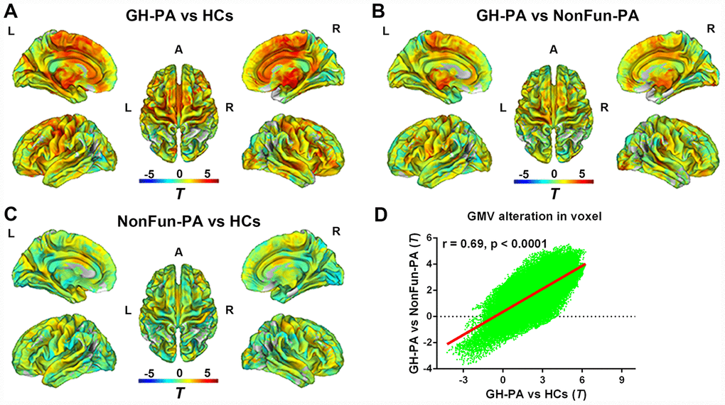 Distribution of WMV alteration in voxel level among three groups. VBM analysis showing the WMV alteration in GH-PA vs HCs (A), in GH-PA vs NonFun-PA (B), in NonFun-PA vs HCs (C). Correlation analysis of WMV alteration between GH-PA vs HCs and GH-PA vs NonFun-PA (D).