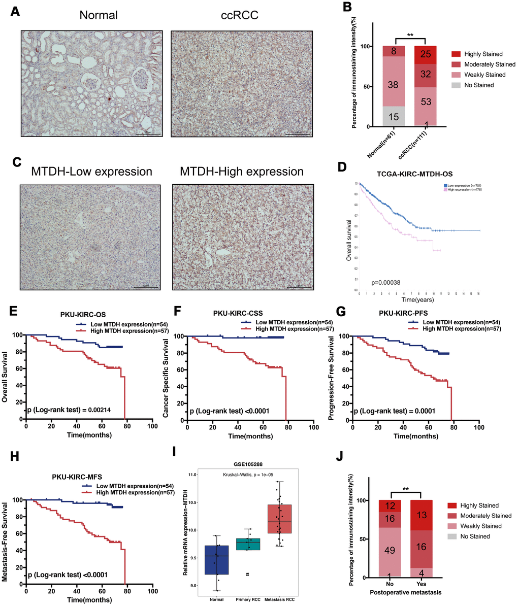 Enhanced MTDH protein expression was associated with poor prognosis of ccRCC. (A) The representative immunostaining of MTDH in normal kidney and ccRCC, (Scale bar, 200 μm). (B) Immunohistochemistry staining analysis of MTDH protein expression in 111 RCC tissues and 61 adjacent normal kidney tissues. (C) The representative immunostaining of high and low MTDH expression in ccRCC tissues was shown. (D) The high MTDH mRNA expression group had a poorer OS than the low MTDH group in TCGA-KIRC dataset based on The Human Protein Atlas website. (E) In 111 ccRCC patients from Peking University First Hospital, compared to those with lower expression levels, ccRCC patients with high MTDH protein expression levels had shorter OS. (F) In 111 ccRCC patients from Peking University First Hospital, compared to those with lower expression levels, ccRCC patients with high MTDH protein expression levels had shorter CSS. (G) In 111 ccRCC patients from Peking University First Hospital, compared to those with lower expression levels, ccRCC patients with high MTDH protein expression levels had shorter PFS. (H) In 111 ccRCC patients from Peking University First Hospital, compared to those with lower expression levels, ccRCC patients with high MTDH protein expression levels had shorter MFS. (I) MTDH mRNA expression in metastasis ccRCC is higher than the MTDH mRNA expression in normal kidney tissues and primary ccRCC in GSE105288 dataset. (J) Compared to those without postsurgical metastasis, ccRCC patients with postsurgical metastasis had higher MTDH protein expression levels in PKU-KIRC dataset.