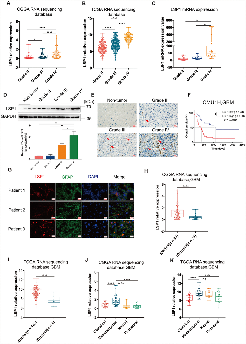 The analyses of LSP1 expression according to WHO grades, GBM subtypes and IDH1 mutant status. (A and B) LSP1 expression was significantly increased in GBM in comparison with WHO grade II and WHO grade III glioma (A, CGGA RNA sequencing dataset, Grade II n = 105; Grade III n = 67; Grade IV n = 138; B, TCGA RNA sequencing dataset, Grade II n = 224; Grade III n = 243; Grade IV n = 155; with one-way ANOVA). (C) qPCR analysis of LSP1 expression in clinical glioma samples (Grade II n = 11; Grade III n = 10; Grade IV n = 21; with one-way ANOVA). (D) Representative western blot images (upper panel) and analyses of LSP1 (lower panel) expressed in clinical tissues (Non-tumor n = 3; Grade II n = 3; Grade III n = 3; Grade IV n = 3; with one-way ANOVA). (E) Representative IHC images of LSP1 staining in clinical non-tumor and glioma samples (200X, scale bar = 50μm). (F) Kaplan-Meier curve evaluating the association of LSP1 expression with the prognosis of GBM patients (LSP1 high vs. low, P = 0.0019; with log-rank test). (G) Representative IF co-staining images of LSP1 and GFAP in clinical GBM samples (200X, scale bar = 50μm). (H and I) LSP1 expression was significantly upregulated in IDH1 wild type GBM (H, CGGA RNA sequencing dataset; I TCGA RNA sequencing dataset; with t test). (J and K) The expression analysis of LSP1 in four subtypes of GBM (J, CGGA RNAseq, Classical n = 47, Mesenchymal n = 50, Neural n = 11, Proneural n = 30; K, TCGA RNAseq, Classical n = 40, Mesenchymal n = 50, Neural n = 27, Proneural n = 38; with one-way ANOVA). ns, *, ** and **** indicate no significance, P P P 