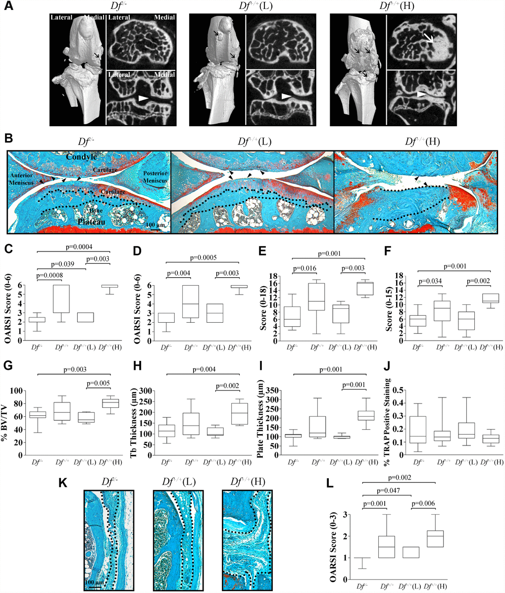 Micro-CT (μCT) and histology of joint tissues of 20-month-old mice. (A) Knee joint μCT of adipsin-deficient (Df-/-), and the wild-type Df+/+(L) and (H) mice. Representative 3-dimensional reconstructions of the joint and axial and coronal images of the subchondral bone compartment. Black arrows indicate osteophytes, white arrows sclerosis and the white arrowheads joint space in the medial compartment. (B) Photomicrographs of representative histological sections of joint tissues: cartilage, meniscus and subchondral bone. The dotted lines delineate subchondral plate thickness and the black arrowheads cartilage alterations. Bar = 100 μm. Original magnification X63. (C–J) Representative box plots of the Osteoarthritis Research Society International (OARSI) score of the (C) medial tibial plateau, and (D) medial femoral condyle; the (E) anterior and (F) posterior menisci; the subchondral bone assessment of the (G) percentage of bone (% bone volume [BV]/total volume [TV]), (H) trabecular (tb) thickness, (I) plate thickness, and (J) tartrate resistant acid phosphatase (TRAP) assay. (K) Photomicrographs of representative histological sections of the synovial membrane and (L) box plot of the OARSI score of the synovial membrane. In (K) the dotted lines delineate synovial membrane thickness. Bar = 100 μm. Original magnification X100. For each box plot, values are the median and interquartile range of Df-/- (n=13), Df+/+ (n=13), Df+/+(L) (n=7) and Df+/+(H) (n=6). p values were determined by the Mann-Whitney test and only significant values are shown.