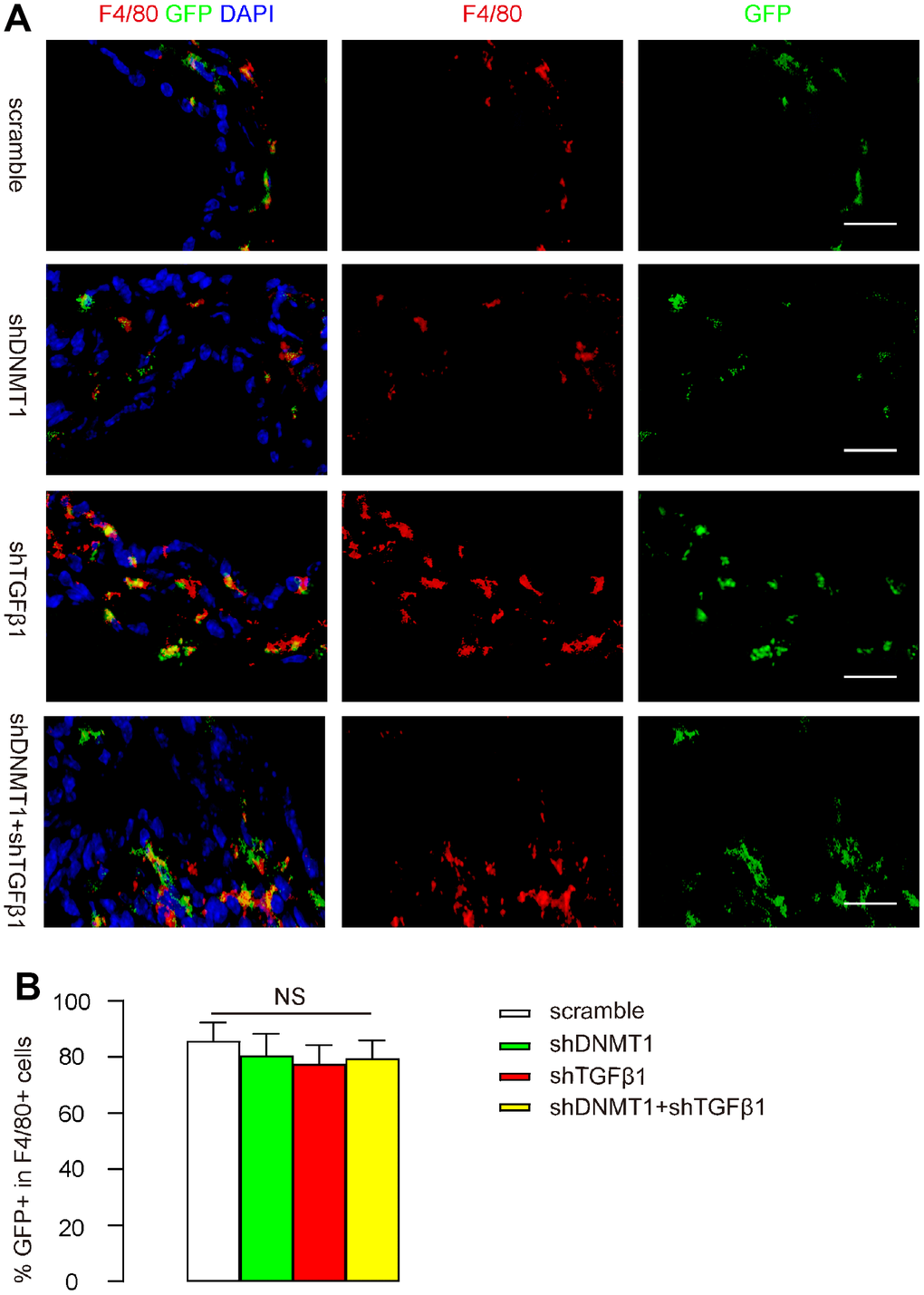 CD68 promoter in AAVs allows specific targeting of macrophages. After LDD was induced in mice, orthotopic injection of these AAVs into LDD-mice was performed. Mice in the scramble group received an orthotopic injection of 100 μl 1011 AAV-pCD68-scramble; mice in the shDNMT1 group received an orthotopic injection of 100 μl 1011 AAV-pCD68-shDNMT1; mice in the shTGFβ1 group received an orthotopic injection of 100 μl 1011 AAV-pCD68-shTGFβ1; mice in the shDNMT1+shTGFβ1 group received an orthotopic injection of 50 μl 0.5X1011 AAV-pCD68-shDNMT1 and 50 μl 0.5X1011 AAV-pCD68-shTGFβ1. Mice were kept for 4 weeks before analysis. (A, B) F4/80 staining and GFP signals are shown by representative images (A) and by quantification of the percentage of GFP+ cells in all F4/80+ cells (B). NS: non-significant. N=7. Scale bars are 20μm.