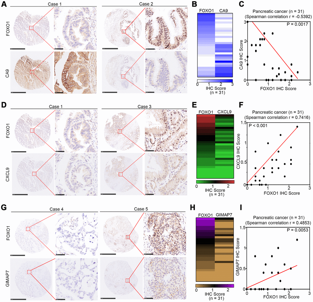 CA9, CXCL9, and GIMAP7 are correlated with FOXO1 in PAAD patient specimens respectively. (A–C) the tissue microarray of PAAD patients (n=31) was stained with FOXO1 and CA9 respectively. The typical image of FOXO1 and CA9 was shown in (A), the IHC scores of FOXO1 and CA9 was shown in (B) and the correlation of these two proteins was shown in (C). (D–F) the tissue microarray of PAAD patients (n=31) was stained with FOXO1 and CXCL9, respectively. The typical image of FOXO1 and CXCL9 was shown in (D), the IHC scores of FOXO1 and CXCL9 was shown in (E) and the correlation of these two proteins was shown in (F). (G–I) the tissue microarray of PAAD patients (n=31) was stained with FOXO1 and GIMAP7, respectively. The typical image of FOXO1 and GIMAP7 was shown in (G), the IHC scores of FOXO1 and GIMAP7 was shown in (H), and the correlation of these two proteins was shown in (I). The scale in A, D, and G represents 1mm or 50um, respectively.