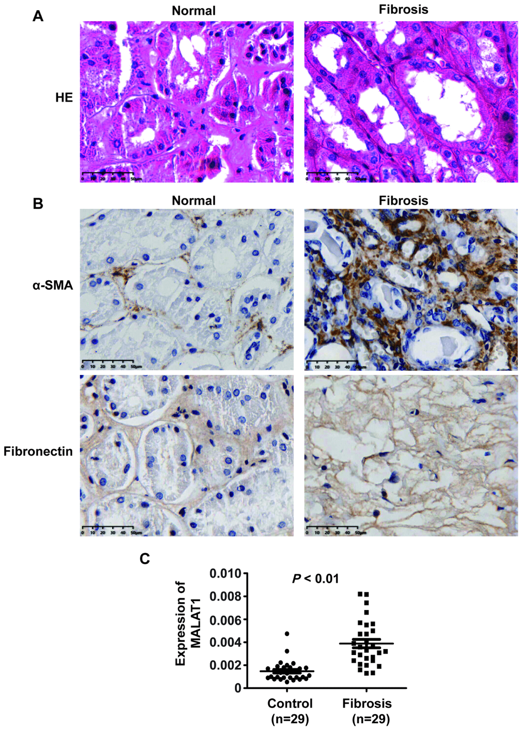 MALAT1 expression was upregulated in renal fibrotic tissues in patients with ON. (A) HE analyses of kidney tissue with severe hydronephrosis from obstructive stones and normal tissue. (B) IHC analyses of α-SMA and ECM deposition in samples from patients with renal fibrosis. (C) qPCR analysis of MALAT1 expression in samples from patients with renal fibrosis].