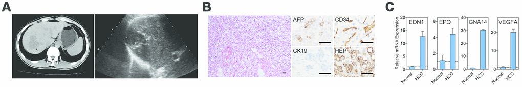 Imaging, histopathology, and mutant HIF2A signaling in the index patient. (A) Abdominal CT imaging and ultrasound revealed a hypodense and hypoechoic mass in the patient’s right liver. (B) Hematoxylin and eosin staining of the resected tumor revealed hepatocellular carcinoma, clear cell variant, with prominent angiogenesis. Tumor cells were positive for AFP and HEP and negative for CK19 by immunohistochemistry; endothelial cells stained positively for CD34. (C) Real-time PCR demonstrated overexpression of the HIF2A transcriptional targets EDN1, EPO, GNA14, and VEGFA within the tumor bed. Scale bars: 50 μm.