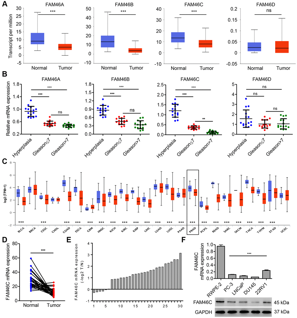 FAM46C expression was decreased in prostate cancer tissues. FAM46A, FAM46B FAM46C and FAM46D mRNA expression levels in prostate cancer tissues (n=52) and noncancerous prostate tissues (n=497) from TCGA database (A), and that in benign prostatic hyperplasia tissues and prostate cancer tissues with different Gleason scores (n=15 per group) from hospital cohort were measured by qPCR (B). (C) FAM46C mRNA expression levels in several cancer types compared with the corresponding normal controls, including bladder carcinoma (BLCA), breast carcinoma (BRCA), cervical cancer (CESC), cholangiocarcinoma (CHOL), colon and rectal adenocarcinoma (COAD), esophageal cancer (ESCA), head and neck squamous cell carcinoma (HNSC), kidney chromophobe (KICH), kidney renal clear cell carcinoma (KIRC), kidney papillary cell carcinoma (KIRP), liver hepatocellular carcinoma (LIHC), lung adenocarcinoma (LUAD), lung squamous cell carcinoma (LUSC), pheochromocytoma and paraganglioma (PCPG), prostate adenocarcinoma (PRAD), rectum adenocarcinoma (READ), sarcomas (SARC), skin cutaneous melanoma (SKCM), thyroid carcinoma (THCA), thymoma (THYM), stomach adenocarcinoma (STAD) and uterine cervical and endometrial carcinoma (UCEC), from TCGA database. Blue, normal samples. Red, tumor samples. (D) FAM46C mRNA expression levels in prostate cancer tissues and corresponding adjacent noncancerous prostate tissues (n=30) from hospital cohort were measured by qPCR. (E) Relative mRNA expression of FAM46C in 30 cases of prostate cancer patients (-log2T/N). (F) FAM46C expression levels in human prostate cancer cell lines (LNCaP, PC-3, 22RV1 and DU145) and human prostate epithelial cell line RWPE-2 were measured by qPCR and western blot. ***P 