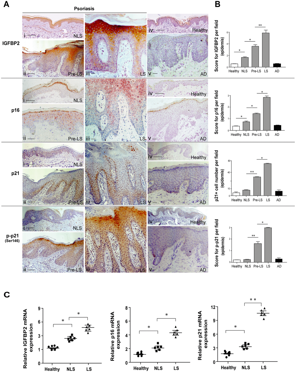 IGFBP2 is enhanced in the suprabasal layers of lesional psoriatic skin, and parallels p16 and p21 senescence markers. (A) IHC analysis of IGFBP2, p21 and phosphorylated p21 (p-p21, red-brown stained), as well as of p16 (red-stained), was performed on paraffin-embedded sections of biopsies obtained from psoriatic skin (n = 10), including non-lesional (NLS) (i), proximal-to-lesion (Pre-LS) (ii) and lesional (LS) zones of evolving plaques (iii), as well as from healthy donors (n = 6) (iv) and AD skin (n = 6) (v). Sections were counterstained with Mayer’s H&E. Bars, 100 μm. (B) Graphs show the mean of four-stage score values for IGFBP2, p16 and p-p21 epidermal expression, or the mean of the number of p21-positive cells ± SD. Two different sections were analysed for each staining, and the positivity was evaluated in five adjacent fields. (C) mRNA expression of IGFBP2, p16 and p21 was analysed by Real-time PCR on total RNA from healthy, NLS, LS biopsies (n = 6) and normalized to GAPDH levels. The results are shown as individual values, mean and ± SD of relative mRNA levels. In (B, C), *p ≤ 0.05, p** ≤ 0.01, as calculated by Mann–Whitney U test.