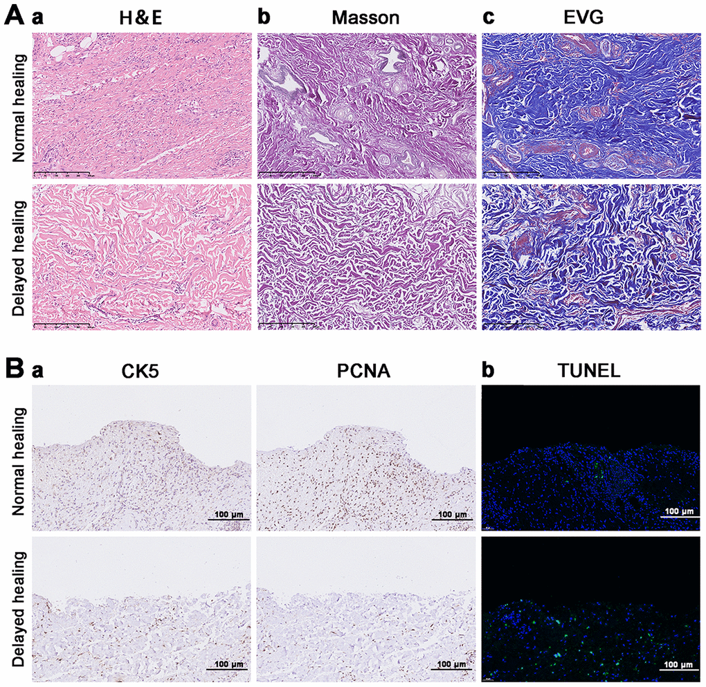 Impaired tissue remodeling and re-epithelization in delayed cutaneous wound tissue. (A) Histological staining of cutaneous wound tissue (200×). (a) H&E staining of sustained inflammatory cells and disordered tissue organization in the delayed cutaneous wound. (b) Masson staining of collagenous (blue) and muscular (red) fibers. Less staining was observed in the delayed wound tissue. (c) EVG staining of elastic fibers. Less staining occurred in the delayed wound tissue. (B) IHC and TUNEL staining of cutaneous wound tissue (200×). (a) CK-5 and PCNA expression levels are reduced in the delayed wound tissue. (b) Increased apoptosis (green cells) occurred in the delayed wound tissue. All the experiments were repeated at least three times.