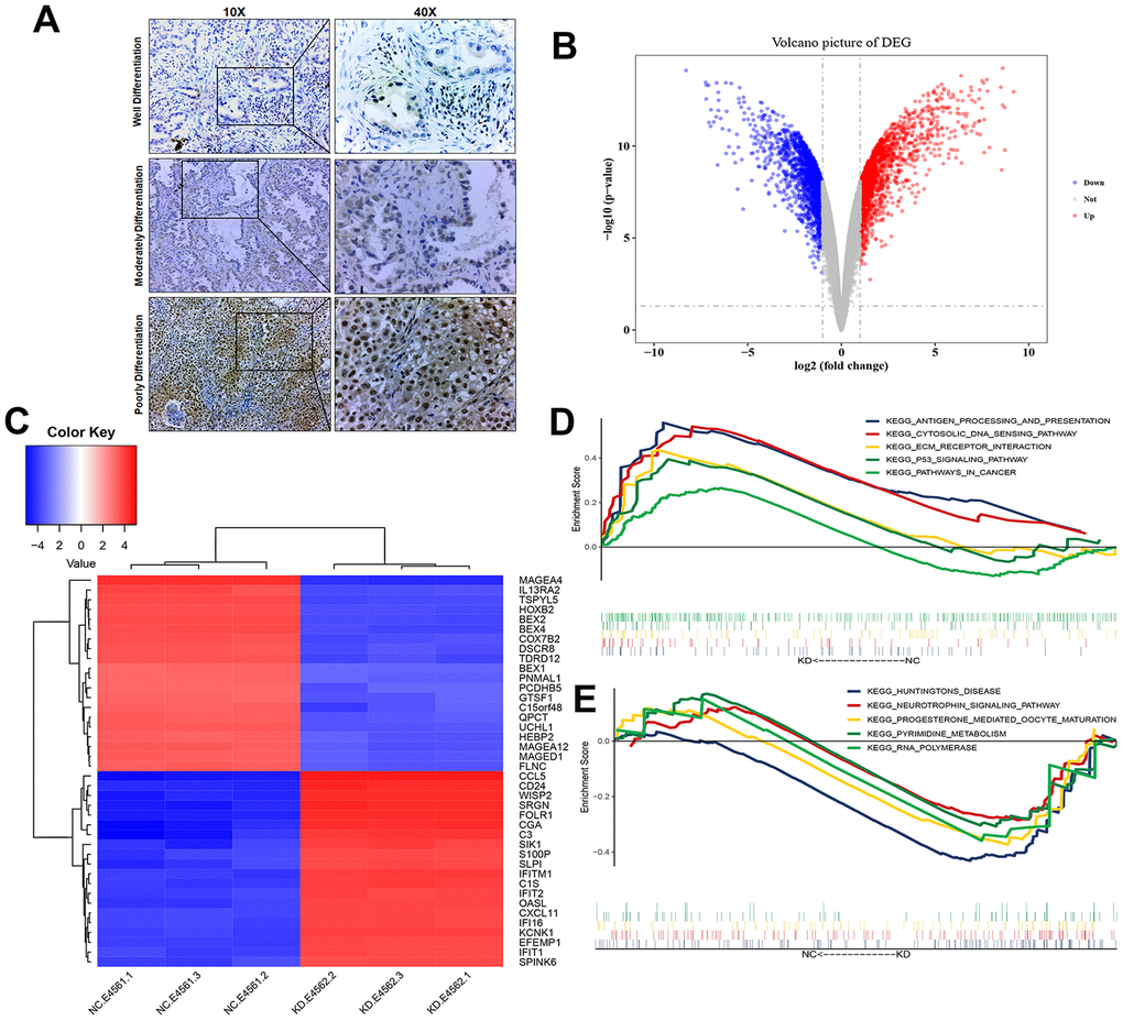 Transcriptional changes of LUAD H1975 cell line induced by knockdown of USP22. (A) Detection of USP22 by immunohistochemistry. (B) Differentially expressed genes in USP22-KD H1975 cells compared to negative control. Red represents up-regulated genes, blue represents down-regulated genes, and gray represents no significantly differentially expressed genes. (C) The expression patterns of these 3806 differentially expressed genes can distinguish between USP22-KD H1975 cells and negative control. (D) Pathways significantly enriched in negative control H1975 cells. (E) Pathways significantly enriched in USP22-KD H1975 cells.