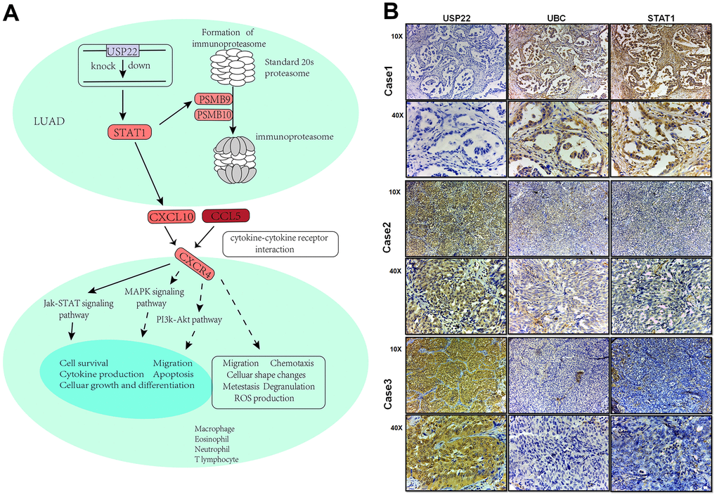 Integrated landscape regulation of STAT1 by USP22-KD. (A) Effect of knocking down USP22 on STAT1 signaling pathway. Blue indicates down-regulated expression, while red indicates up-regulated expression. (B) Detection of USP22, UBC and STAT1 by immunohistochemistry in LUAD.