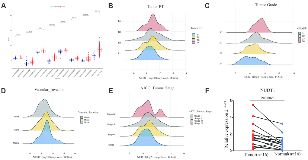 NUDT1 is overexpressed in HCC tissues. (A) NUDT1 mRNA levels in HCC and normal liver tissues in TCGA and GEO datasets. Note: TCGA dataset (tumor = 370; normal = 50); GSE14323 (tumor = 55; normal = 60); GSE14520 (tumor = 225; normal = 220); GSE41804 (tumor = 20; normal = 20); GSE45436, (tumor = 93; normal = 41); GSE51401 (tumor = 30; normal = 34); GSE62232 (tumor = 81; normal = 10); GSE6764 (tumor = 35; normal = 40). (B–E) Density plot shows the relationship between NUDT1 mRNA expression and clinicopathological characteristics, such as, tumor pathology stage (tumor PT), tumor grade, AJCC tumor stage, and degree of vascular invasion. As shown, high NUDT1 mRNA expression is associated with poor prognosis for patients with HCC belonging to stage IV, G4, macrovascular invasion, and T4. (F) Quantitative RT-PCR analysis of NUDT1 mRNA expression in 16 pairs of HCC and adjacent normal liver tissues is shown. NUDT1 is overexpressed in HCC tissues compared with adjacent normal liver tissues (ANLTs; P 