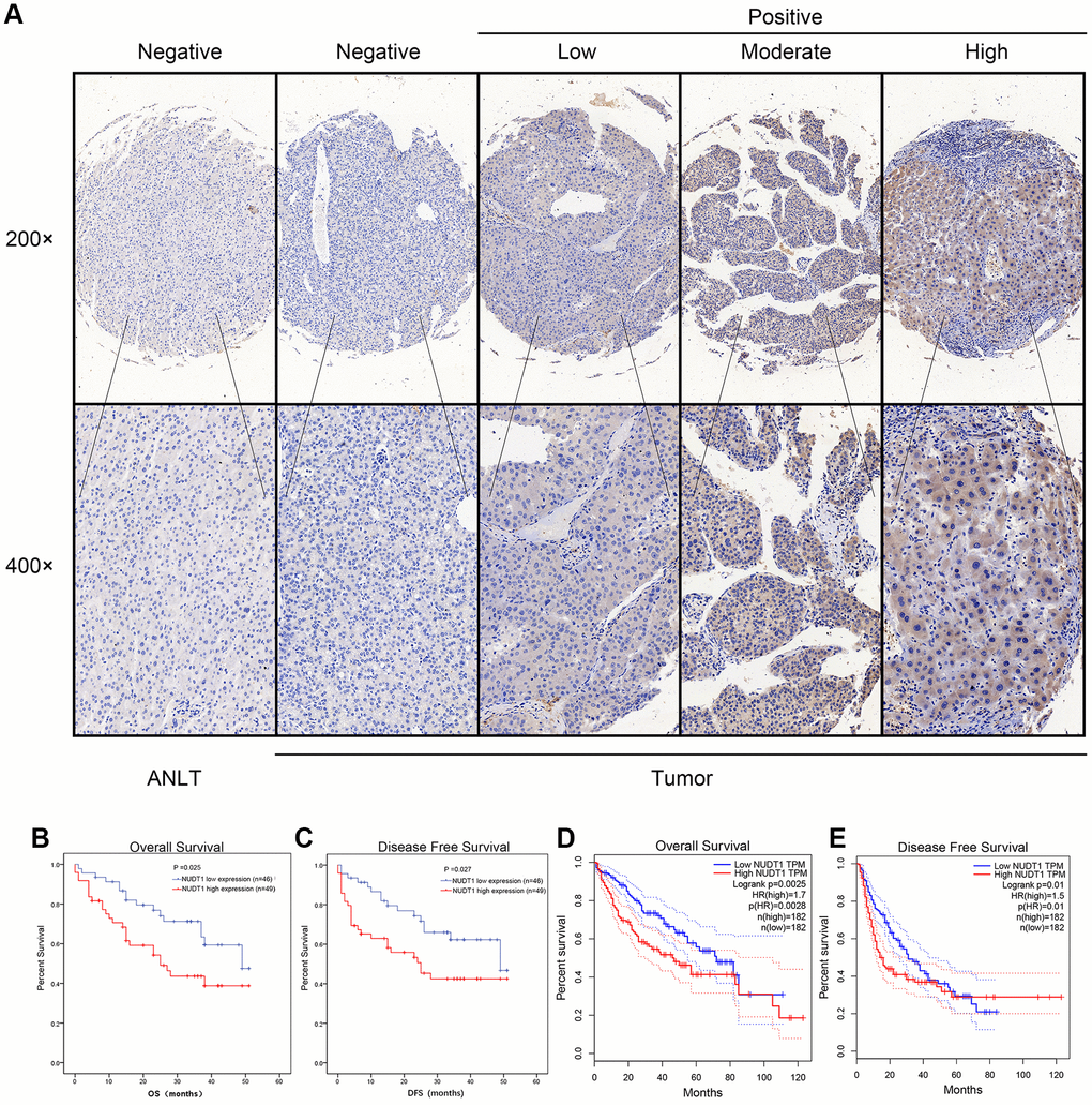 NUDT1 protein is overexpressed in HCC tissues. (A) Representative images show immunohistochemical staining results in 95 pairs of HCC and normal liver tissues samples. Normal liver tissues show negative NUDT1 expression, whereas, HCC tissues show negative or low, moderate, and high NUDT1 protein expression as shown. The scale bars indicate 50μm (200x) and 20 μm (400x). (B, C) Kaplan-Meier survival curves show overall survival (OS) and disease-free survival (DFS) curves for HCC patients with high (n=49) and low (n-46) levels of NUDT1 protein expression. (D, E) Kaplan-Meier survival curves show overall survival (OS) and disease-free survival (DFS) curves for HCC patients from the GEPIA database.