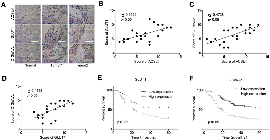 Evaluation of the levels of GLUT1 and O-GlcNAc in HCC and their clinical significance. (A) Immunohistochemistry technology was used to assess the protein levels of ACSL4, O-GlcNAc and GLUT1 in HCC tissues and adjacent normal tissues (Scale bar = 100 μm). (B–D) Pearson correlation analysis of the correlations between the levels of ACSL4, O-GlcNAc and GLUT1 in HCC tissues. (E, F) Kaplan-Meier analysis of the relationship between GLUT1/O-GlcNAc levels and the overall survival of patients with HCC.