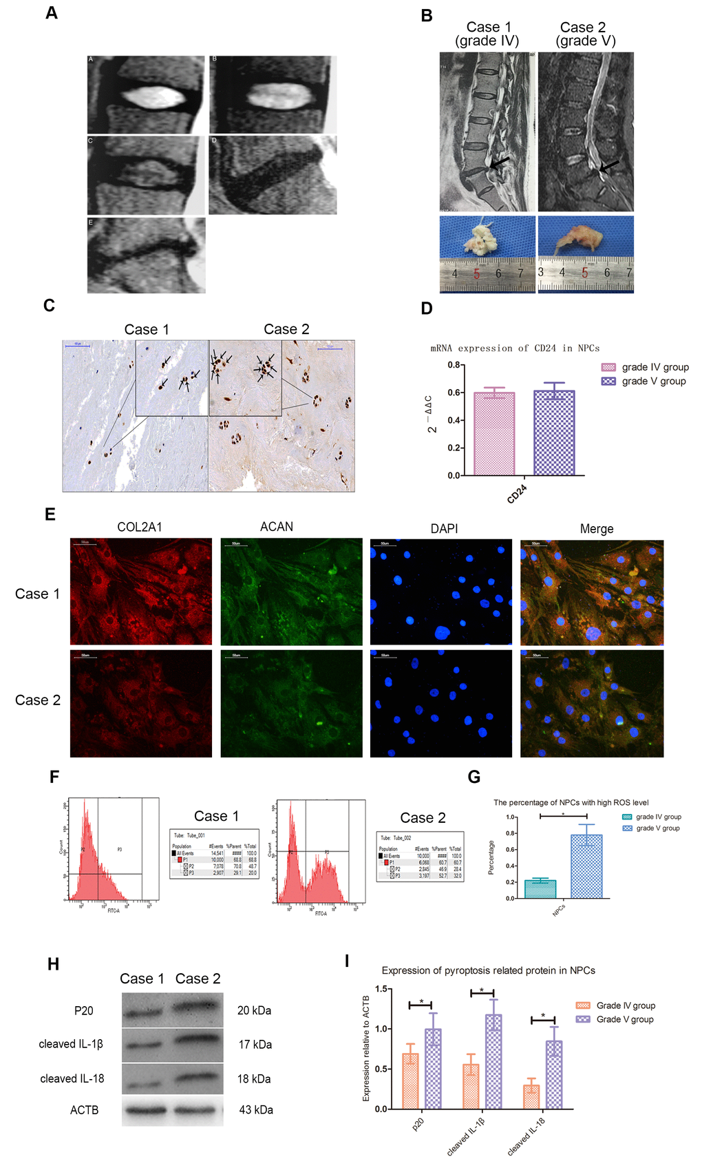 Cleaved CASP1, IL-1β and IL-18 was higher expressed in NPCs with higher ROS level. (A) Magnetic resonance images of the discs of patients with intervertebral disc degeneration of different Pfirrmann’s classifications. A, B, C, D and E represented the images of patients with grade I, II, III, IV and V intervertebral disc degeneration. (B) The representative spinal magnetic resonance images and gross pictures of included patients of grade IV and V treated with transforaminal endoscope. (C) The immunohistochemical staining for detection of CASP1 in tissues from patients of grade IV and V (magnification: ×200, scale bar = 100μm). (D) The mRNA expression of CD24 in nucleus pulposus cells isolated from included patients with intervertebral disc degeneration of grade IV and V. (E) The representative images of immunofluorescence staining for detection of COL2A1 and ACAN in the cultured nucleus pulposus cells from patients of grade IV and V (magnification: ×400, scale bar = 50μm). (F) The flow cytometry for detecting the reactive oxygen species level in the cultured nucleus pulposus cells from case1 and case 2. (G) The comparison of the percentage of nucleus pulposus cells with high ROS level of patients with intervertebral disc degeneration of grade IV and V. (H) The representative western blot images showing the expression of p20, cleaved IL-1β, and cleaved IL-18 in the nucleus pulposus cells isolated from patients of grade IV and V. (I) The comparison of pyroptosis related proteins between the patients of grade IV and V based on western blot results. The data were presented as the mean ± SEM. *P 