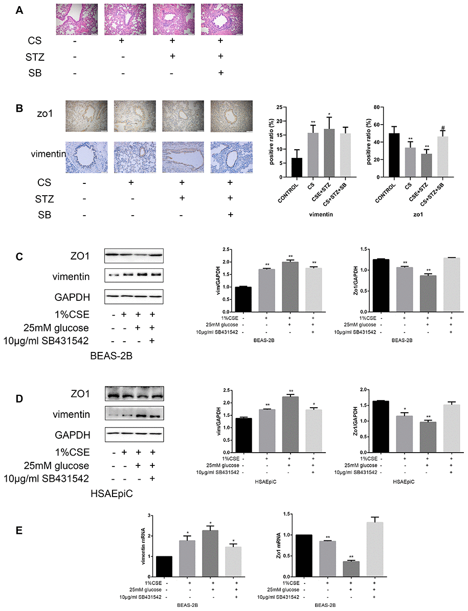 High glucose levels and CS exposure induced EMT through the TGF-β signaling pathway. (A) Hematoxylin and eosin staining of bronchioles from control, COPD, COPD diabetic and SB431542-injected COPD diabetic rats. (B) Immunohistochemical results and positive ratios of Zo1 and vimentin in control, COPD, COPD diabetic and SB431542-injected COPD diabetic rats. (C–F) AECs were treated with 25 mM glucose and 1% CSE for 24 hours, and SB431542 was added 30 minutes before further treatment. Western blots of Zo1 and vimentin in BEAS-2B (C) and HSAEpiC (D) cells. qRT-PCR analyses of Zo1 and vimentin in BEAS-2B (E) cells.