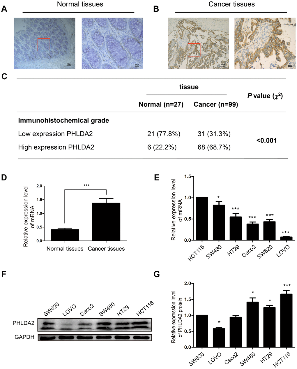 PHLDA2 expression in CRC tissue, adjacent normal tissue, and cell lines. (A–C) Immuno-histochemical staining and analysis of PHLDA2 protein in CRC tissue and adjacent normal tissue (magnification, ×100 and ×400). (D) RT-qPCR was used to detect mRNA expression levels of PHLDA2 in 29 CRC tissues and paired normal tissues. (E–G) RT-qPCR and western blot analyses were used to detect mRNA and protein expression of PHLDA2 in six CRC cell lines. Data are shown as mean ± SD; *P P P 