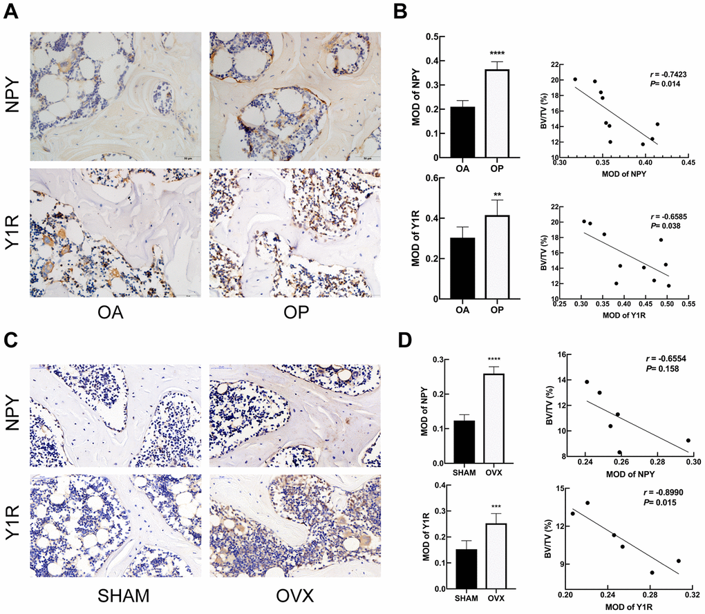 NPY and Y1R were upregulated in subchondral cancellous bone of OP patients and OVX rats. Immunohistochemical analysis of bone tissue between OA and OP group (A), and between SHAM and OVX group (C) for NPY and Y1R (x 400). Correlation between BV/TV and the expression of NPY and Y1R in OP group (B) and OVX group (D). The data are expressed as the means ± SD. r=correlation coefficient assessed by Pearson correlation analysis. **P