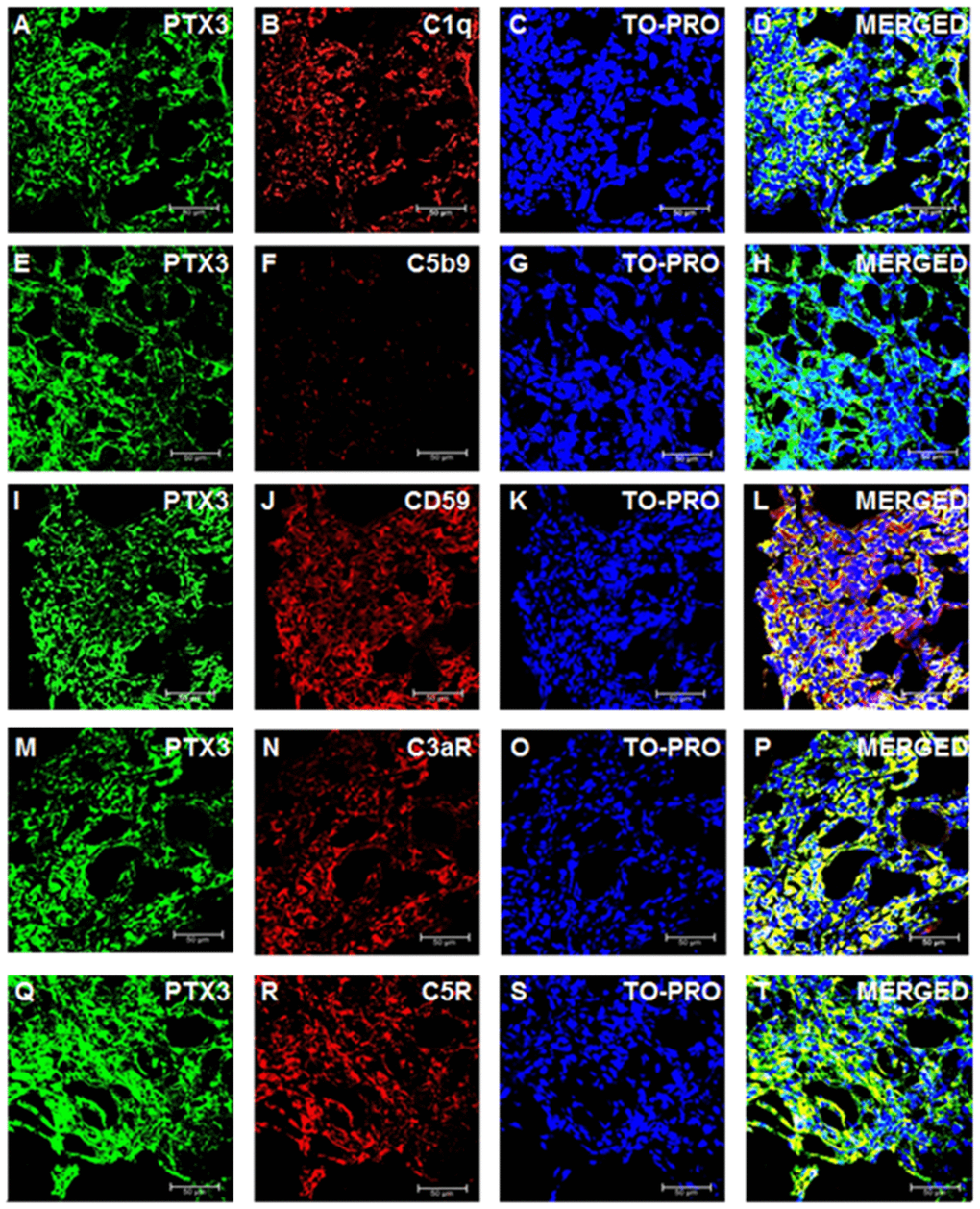 Complement system factors’ expression and co-localization with PTX3 in renal clear cell carcinoma. Intra-tumoral expression of PTX3 (green) and co-localization with C1q (A-D), C5b9 (E-H), CD59 (I-L), C3aR (M-P), C5R (Q-T).