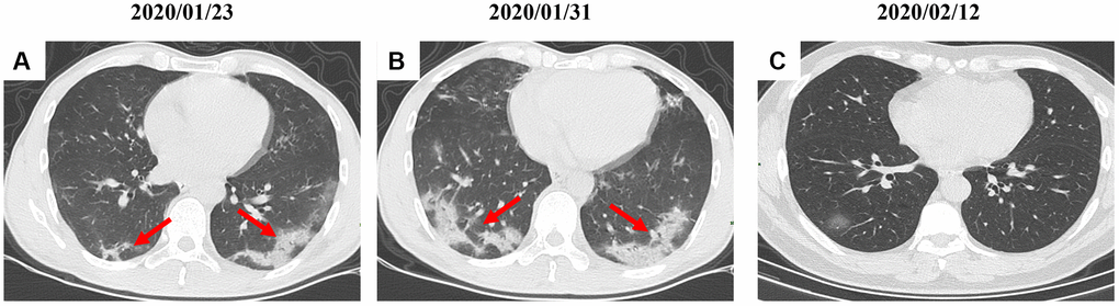 A serial CT images after admission of a 54-year-old female patient. (A) Patch ground-glass opacity mainly located in the left lower lobe. (B) Significant larger patch ground-glass opacities were observed in both lower lobes after 8 days. (C) Follow-up CT scans on day 20 after admission show a remarkable improvement. Typical lesions were marked with red arrows.