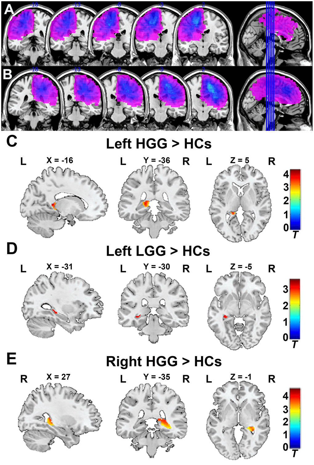 Tumor overlapping map across glioma patients and VBM analysis. (A) All tumor masks in left hemisphere gliomas (including left LGG and HGG) overlapped in the Ch2bet template. (B) All tumor masks in right hemisphere gliomas (including right LGG and HGG) overlapped in the Ch2bet template. VBM analysis showing GMV increases in the ipsilateral hippocampus in the left HGG group (C), left LGG group (D), and right HGG group (E) compared to HCs (FDR-corrected, p  20). L: left hemisphere, R: left hemisphere.