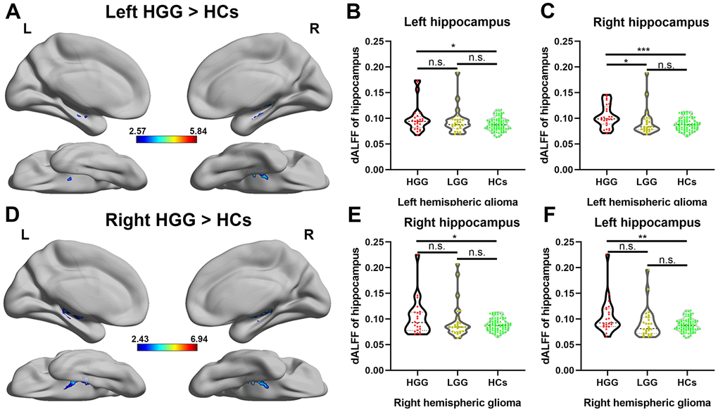 Alteration of the dALFF in high-grade glioma patients. (A) The left HGG group showed significantly increased temporal variability of the dALFF in the bilateral hippocampus compared to HCs using a two-sample t-test (FDR-corrected cluster level p  10). (B, C) For left hemispheric high-grade glioma patients, a significant increase in the dALFF was observed in both the entire left and right hippocampi in the HGG group compared to HCs (one-way ANOVA with Bonferroni correction, * p D) The right HGG group showed significantly increased temporal variability of the dALFF in the bilateral hippocampus compared to HCs using a two-sample t-test (FDR-corrected cluster level p  10). (E, F) For right hemispheric glioma, a significant increase in the dALFF was observed in both the entire left and right hippocampi in the HGG group compared to HCs (one-way ANOVA with Bonferroni correction, * p 