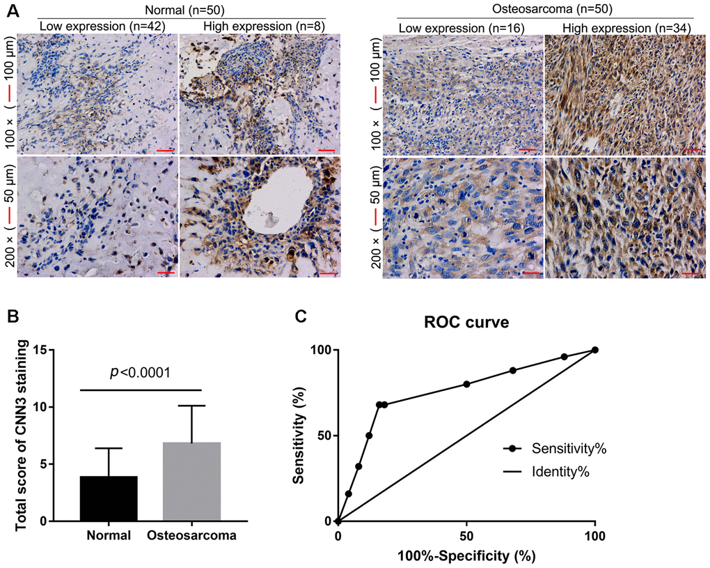 CNN3 expression in osteosarcoma and normal specimens detected by immunohistochemistry. (A) Representative images. (B) Statistical results of the CNN3 staining total score. pt-tests. (C) Receiver operating characteristic (ROC) curve analysis to assess the diagnostic value of CNN3 in osteosarcoma using the GraphPad Prism 7.0 version.