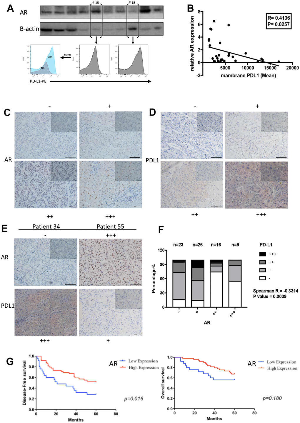 The negative correlation between AR and PD-L1 in vivo. (A) AR protein expression and membrane PD-L1 detection in patients’ samples (B) The correlation results between AR and PD-L1 (C) Representative images for scoring the AR IHC staining. (D) Representative images for scoring the PD-L1 IHC staining. (E) Representative images to show the comparison of AR and PD-L1 staining in the same patient. (F) Spearman correlation analysis for AR and PD-L1 based in our stained clinical samples (P value= 0.0039). (G) Survival curve analysis in different AR expression.