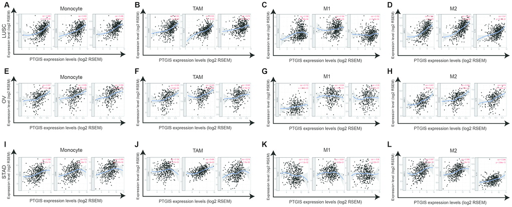 PTGIS expression correlated with macrophage polarization in LUSC (lung squamous cell carcinoma), OV (ovarian serous cystadenocarcinoma) and STAD (stomach adenocarcinoma). Markers included CD14, CD86 and FCGR3A for monocytes; CD68, CCL2 and CCL5 for TAMs (tumor-associated macrophages); NOS2, CXCL10, and TNF for M1 macrophages; and MRC1, CD163, and IL10 for M2 macrophages. (A–D) Scatterplots of correlation between PTGIS expression and the expression of gene markers of monocytes (A), TAMs (B), and M1 (C) and M2 macrophages (D) in LUSC (n = 496). (E–H) Scatterplots of correlation between PTGIS expression and the expression of gene markers of monocytes (E), TAMs (F), and M1 (G) and M2 macrophages (H) in OV (n = 537). (I–L) Scatterplots of correlation between PTGIS expression and the expression of gene markers of monocytes (A), TAMs (B), and M1 (C) and M2 macrophages (D) in STAD (n= 407).