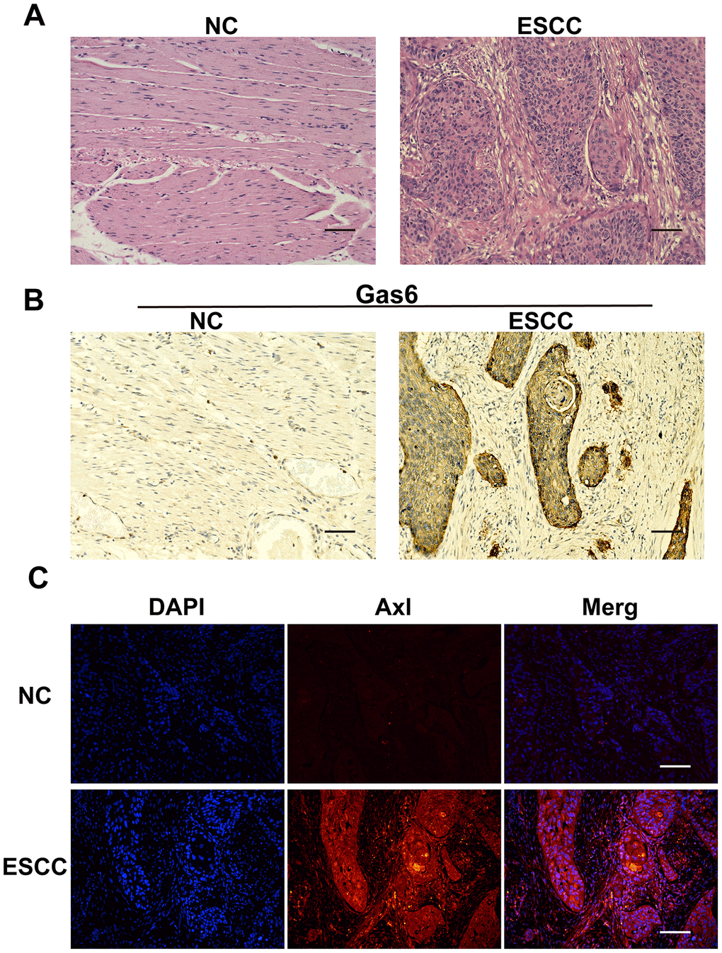 Gas6 and Axl expression in ESCC tissues. (A) HE staining; NC: nontumor esophageal tissue, ESCC: esophageal squamous cell carcinoma tissue. (B) Immunohistochemical assessment of Gas6 expression in NC and ESCC tissues. (C) Immunofluorescence assessment of Axl expression in NC and ESCC tissues; DAPI-labeled nuclei are in blue, and the merge imaged shows Axl and nuclear overlap. Scale bars indicate 50 μm.