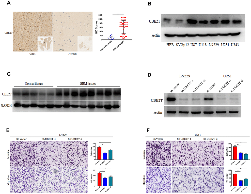 Ubiquitin-conjugating enzyme E2T (UBE2T) expression is higher in glioblastoma (GBM) and it promotes cell invasion and migration. (A) Immunohistochemical staining of UBE2T in human GBM tissues compared with the findings in normal brain tissues (×100). Scale bar, 100 μm. (B) Immunoblotting of UBE2T protein levels in normal human astrocytes (HEB and SVG p12) and GBM cell lines (U87, U118, LN229, U251 and U343). Expression levels were normalized to those of β-actin. (C) Immunoblotting of UBE2T protein levels in normal brain and GBM tissues. Expression levels were normalized to those of GAPDH. (D) Transfection efficacy of UBE2T short hairpin RNA (shRNA) in LN229 and U251 cells was analysed via immunoblotting. (E, F) The effects of UBE2T shRNA on the invasion and migration of LN229 (E) and U251 (F) cells. (Error bars indicate the SEM of three independent experiments. Two-tailed Student’s t-test. *, P 