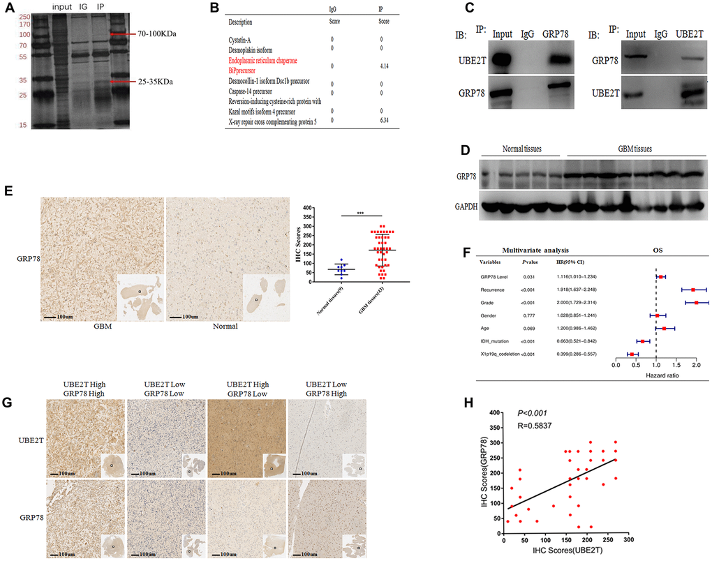 Ubiquitin-conjugating enzyme E2T (UBE2T) interacts with GRP78 and GRP78 is an independent risk factor for gliomas. (A) SDS-PAGE analysis of UBE2T immunoprecipitates. The indicated band was excised and examined via mass spectrometry. (B) The mass spectrometry result allowed the identification of proteins. (C) U251 cell lysates were incubated with Protein A/G Sepharose conjugated with anti-UBE2T and anti-GRP78 antibodies. The immunoprecipitates were detected via immunoblotting. (D) Immunoblotting of GRP78 protein levels in normal brain and GBM tissues. Expression levels were normalized to those of GAPDH. (E) Immunohistochemistry of GRP78 in human GBM tissues compared with that in normal brain tissues (×100). Scale bar, 100 μm. (F) Multivariate analysis of the relationship of GRP78 with overall survival (OS) in patients with glioma using the Chinese Glioma Genome Atlas RNA sequencing dataset. (G) Representative images of the immunohistochemical staining of UBE2T and GRP78 in glioblastoma (n = 43, ×100). Scale bar, 100 μm. (H) The correlation between UBE2T and GRP78 protein levels was analysed in glioblastoma tissues. The samples were classified into low and high expression groups based on the UBE2T and GRP78 IHC scores. The protein expression level of GRP78 was positively correlated with the GRP78 expression level. Each dot indicates the relative protein expression level. Data were analysed using Pearson’s correlation coefficient. (Error bars indicate the SEM of three independent experiments. Two-tailed Student’s t-test. *, P 