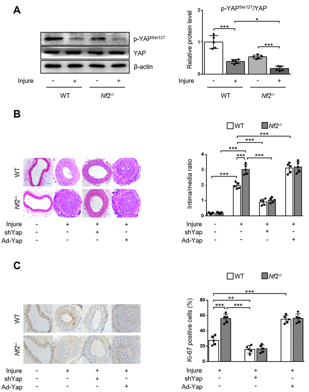 YAP is required for NF2 knockdown-mediated neointima hyperplasia after vascular injury. WT and Nf2-/- mice received injection of shCon, shYap, Ad-Con and Ad-Yap into the injured left common carotid artery via the external carotid artery immediately after injury and then incubated for 30 min. The mice subsequently received intravenous injection of these adenovirus via tail vein at 7, 14, 21 days after injury. (A) The relative protein expression levels of p-YAPSer127 and YAP were determined by immunoblotting in arteries of WT and Nf2-/- mice at day 28 after vascular injury (n=5). (B) Representative H&E staining of carotid arteries from WT or Nf2-/- mice treated as above mentioned (left) and corresponding quantification for ratio of intima/media (right) were shown (n=5). Magnification 200×. (C) Immunohistochemistry staining of Ki-67 (brown) in sections of carotid arteries from WT or Nf2-/- mice treated as above mentioned (left) and corresponding quantification for Ki-67-positive cells within neointima (right) were shown (n=5). Magnification 200×. Data are shown as mean ± S.D. *PPP