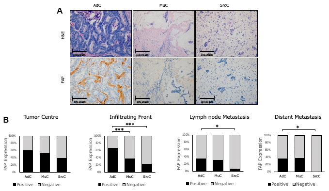 Immunohistochemical FAP staining according to CRC histologic subtypes. (A) Higher percentage of positive staining was observed in conventional adenocarcinoma (AdC) with respect to mucinous (MuC) and signet ring cell carcinomas (SrcC) in the infiltrating front primary tumour (x200). (B) FAP staining intensity was scored as negative or positive. The scores were quantified in each histologic subtype and statistical significance was determined by Chi-Square test (*p