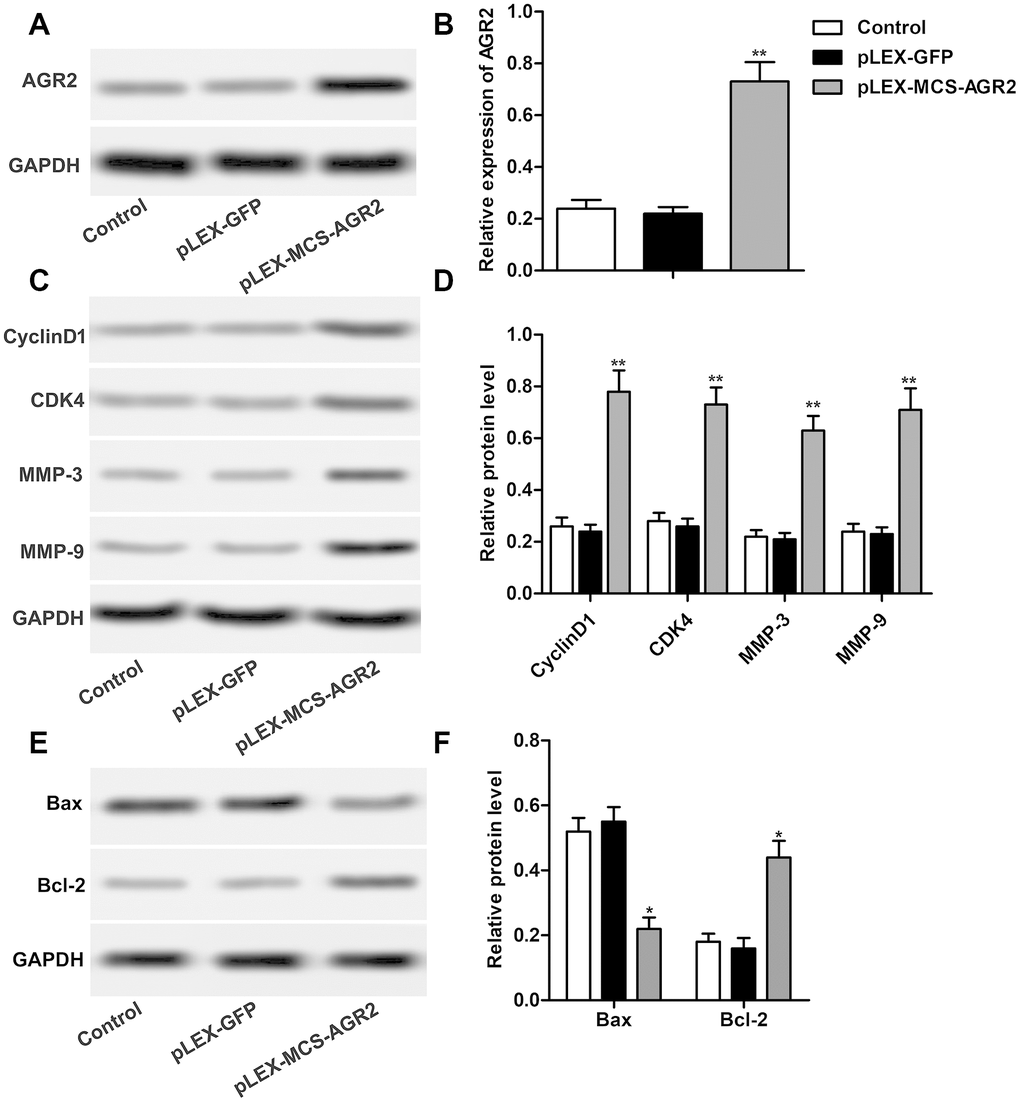 Overexpression of AGR2 promotes the progression of HCC. (A, B) Western blot showed the expression of AGR2 and data statistics was also shown. (C, D) Western blot showed that expression of CyclinD1, CDK4, MMP-3 and MMP-9. Data statistics was also shown. (E, F) Western blot showed that expression of Bax and Bcl-2. Data statistics was also shown. *P **P 