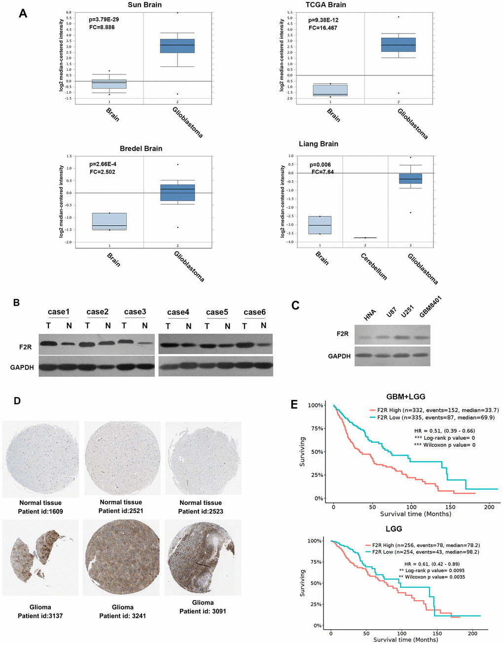 F2R is significantly upregulated in glioma and predicts poor survival. (A) Analysis of the expression pattern of F2R in normal brain and glioblastoma tissue, based on the Oncomine database of Sun, TCGA, Bredel and Liang glioblastoma datasets. (B) Western blotting detection of the F2R expression in 6 pairs of malignant glioma and normal tissues. (C) Western blotting detection of the F2R expression in normal human brain cells and three glioma cell lines. (D) The expression of F2R in normal tissue and malignant glioma tissues using the Human Protein Atlas database. (E) F2R was significantly associated with overall survival in glioma patients, using a Kaplan–Meier curve and a log-rank test. GBM, Glioblastoma multiforme; LGG, Brain Lower Grade Glioma. Data are presented as the mean ± SEM.