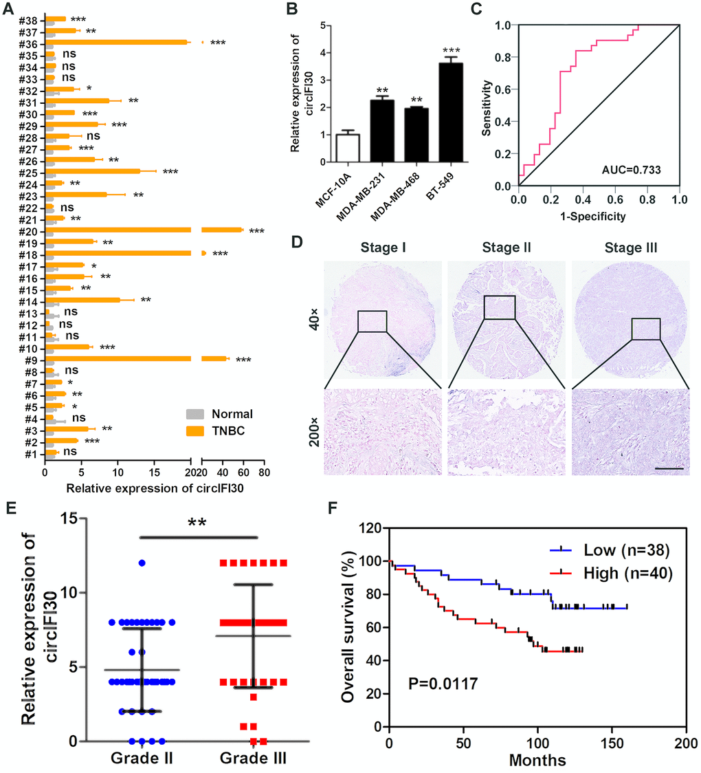 circIFI30 is up-regulated in TNBC and associated with the progression and poor prognosis of TNBC patients. (A) Relative expression of circIFI30 in TNBC tissues and adjacent non-tumor tissues was detected by qRT-PCR (n = 38). (B) Relative expression of circIFI30 in cell lines was determined by qRT-PCR. (C) ROC curve was applied to evaluate the diagnostic value of circIFI30 for TNBC. (D) Representative images of circIFI30 expression in TNBC tissues were detected by ISH assays. Scale bar, 100 μm. (E) Dot distribution graph of circIFI30 ISH staining scores was shown in TNBC patients with different pathological grades. (F) Kaplan-Meier survival curve of overall survival in 78 patients with TNBC according to the circIFI30 expression. Patients were stratified into high expression and low expression group by median expression. Data were showed as mean ± SD, *P P P 