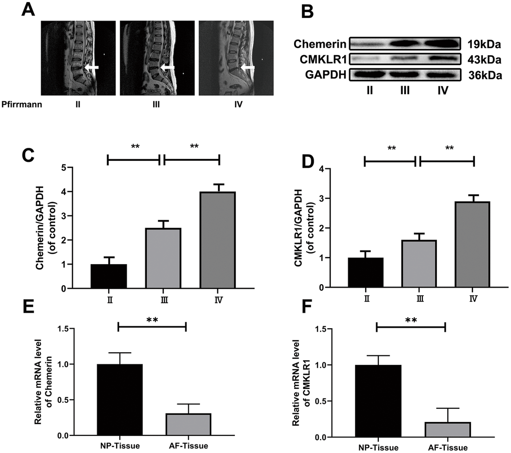 The expression levels of chemerin, and CMKLR1 in different degenerated human NP and blood tissues. (A) Representative MRI images of three different degrees of IDD patients. (B) The expression of levels of chemerin, and CMKLR1 from NPCs of different degrees of IDD patients were analyzed by western blotting. (C, D) Quantification of chemerin, and CMKLR1 immunoblots. (E, F) RT-PCR showed that the mRNA levels of chemerin, and CMKLR1 in the NP tissue were significantly higher compared with AF tissue. Data are represented as mean ± SEM of three independent experiments, each done in triplicate. Significant differences between groups are indicated as **p 