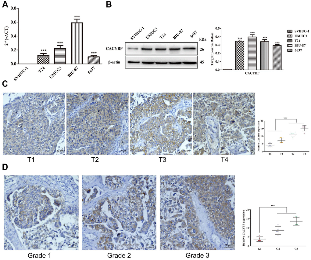 The overexpression of CACYBP in patients with BCa and its correlation with grades and T-stages. The results of RT-qPCR of CACYBP expression in bladder cancer cells and normal urothelial cells (A). Western blot analysis showed that the expression of CACYBP was higher in BCa cell lines than in normal urothelial cells (B). Increasing expression levels of CACYBP were detected by immunohistochemistry (C). CACYBP was also increased in various grades incrementally (D).